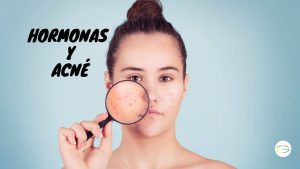 ormonas y acne