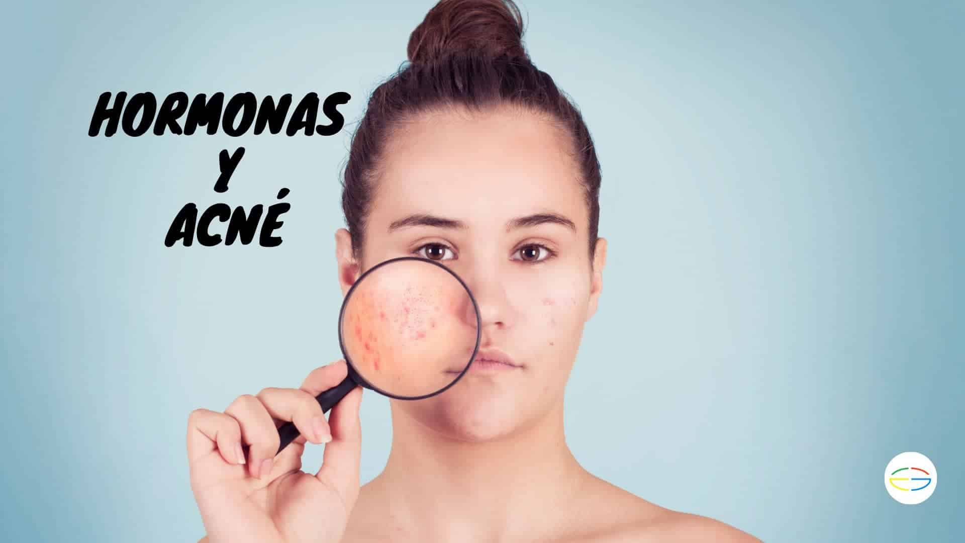 ormonas y acne